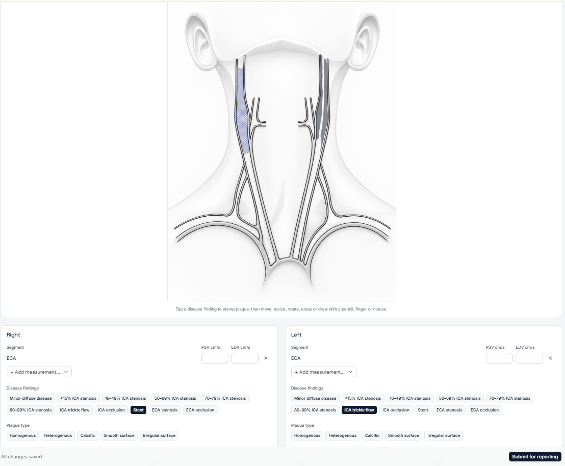 VascIQ interactive carotid worksheet — annotated vessel diagram with bilateral segment measurements and structured disease finding options