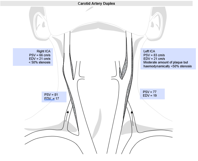 Carotid artery duplex worksheet with bilateral PSV and EDV measurements