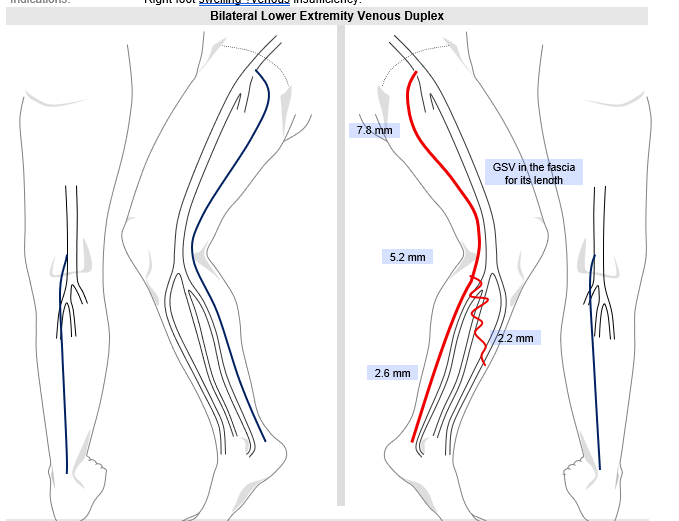 Bilateral lower extremity venous duplex diagram showing reflux patterns