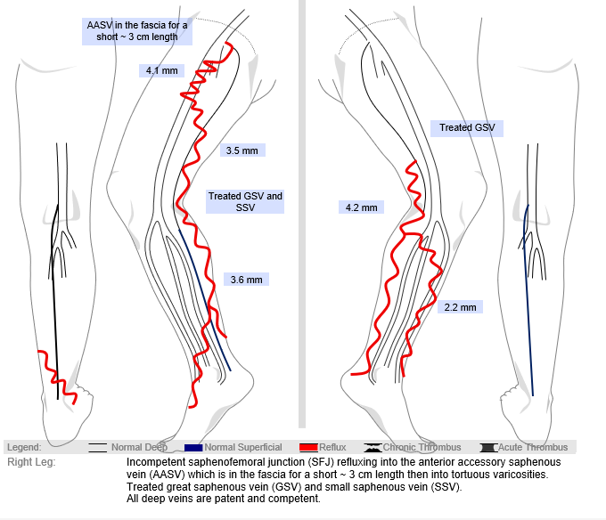 Right leg venous duplex report with reflux legend and structured clinical impression